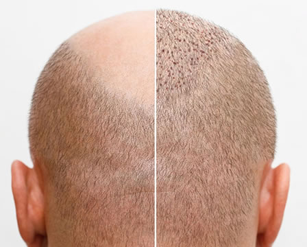 Advanced Sapphire FUE Hair Transplant